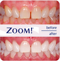 Tooth Whitening Southgate